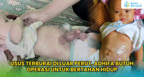 Usus Terburai Di Luar Perut, Adhifa Butuh Operasi Segera